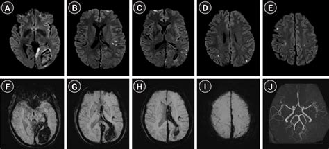 Initial Brain Magnetic Resonance Imaging Shows Multiple Embolic