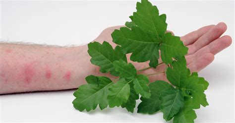 Poison Oak Treatment Symptoms And 5 Natural Treatments David Avocado Wolfe