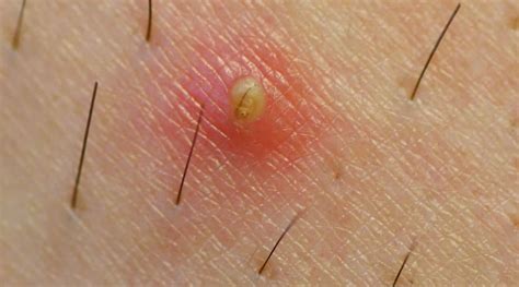59 Hq Images Ingrown Hair Under Armpit Pictures How To Prevent Ingrown Armpit Hair 14 Steps