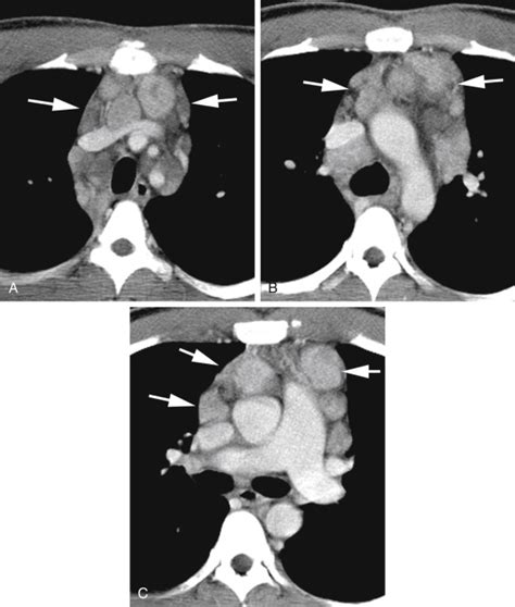 Mediastinum Lymph Node Abnormalities And Masses Radiology Key