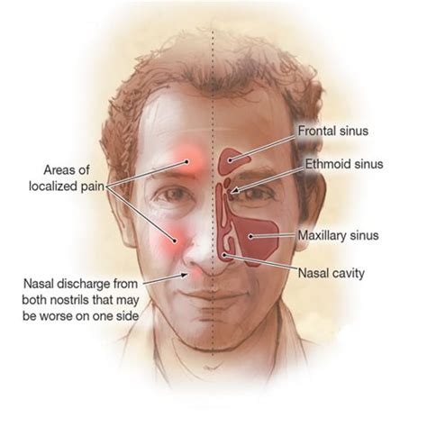Acute Sinusitis Acute Rhinosinusitis Causes The Cavities Around Your Nasal Passages Sinuses