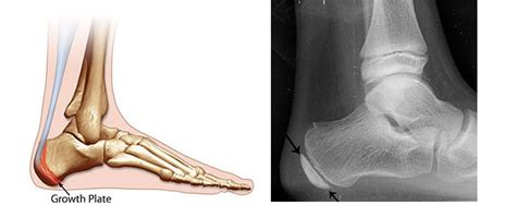 Severs Disease Calcaneal Apophysitis Ankle Foot And Orthotic Centre