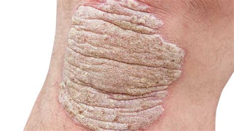 Pustular Psoriasis Pictures Symptoms And Treatments