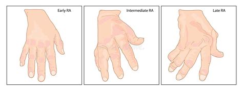 Hand With Rheumatoid Arthritis Stock Vector Illustration Of Anatomy Early 77340469