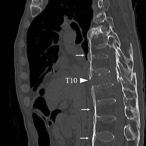 Sagittal Ct Image Of Thoraco Lumbar Spine Demonstrating Transverse