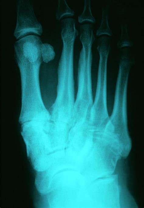 Osteoarthritis Of Foot Photograph By Dr P Marazziscience Photo Library