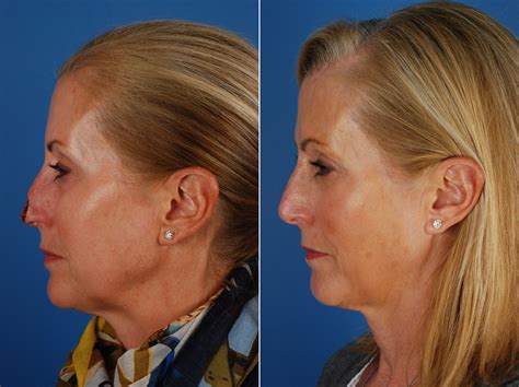 Skin Cancer Treatment Before And After