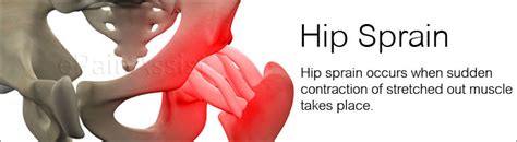 What Is Hip Sprain Treatment Symptoms Exercises Causes Diagnosis