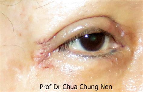 Eyelid Surgery By Prof Dr Cn Chua Doc Could You Balance My Eyes