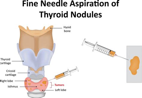 Fine Needle Aspiration Of Thyroid Nodules Otolaryngology Specialists