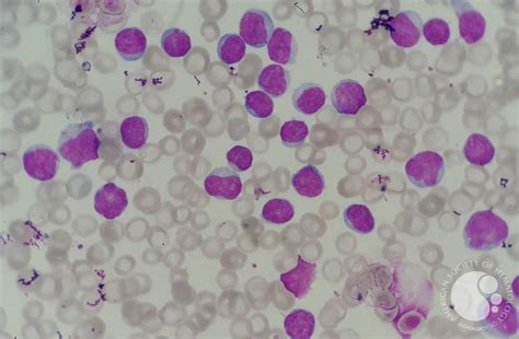 Chronic Lymphocytic Leukemia Cll With Presence Of Pro Lymphocytes 2