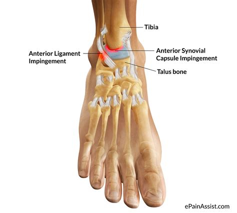 What Is Ankle Impingement Symptoms Causes Treatment Recovery Period Exercises