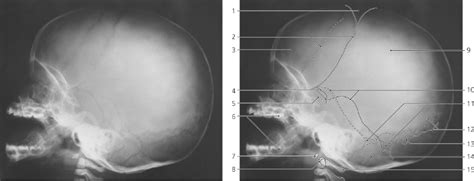 Skull | Radiology Key