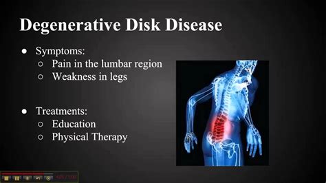 Musculoskeletal Disorder Youtube