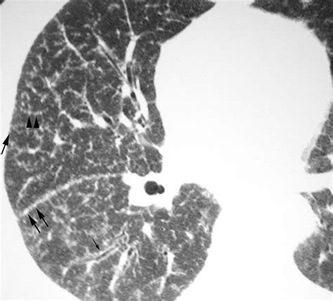 Challenges In Pulmonary Fibrosis · 1 Use Of High Resolution Ct