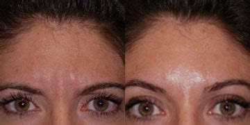It usually takes a few days, but in some cases, it may be sooner. How Long Does Botox Take to Work if Used for Tension ...
