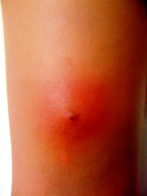 Dont Know How Ya Do It Brown Recluse Spider Bite