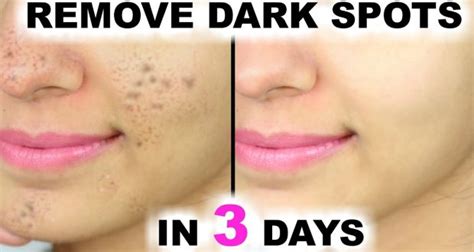 it removes the spots from your face in just 3 nights top 5 diy