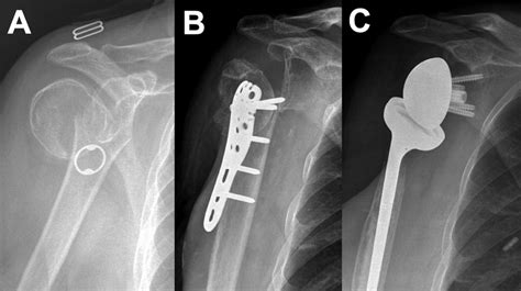Example Of A Case With A Surgical Neck 2 Part Proximal Humeral Fracture