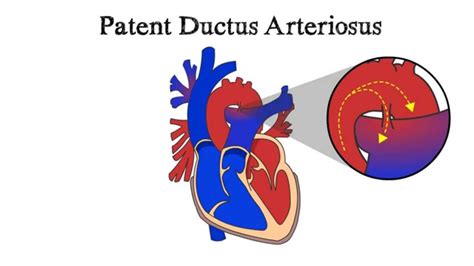 Patent Ductus Arteriosus Pda Patent Ductus Arteriosus Ductus
