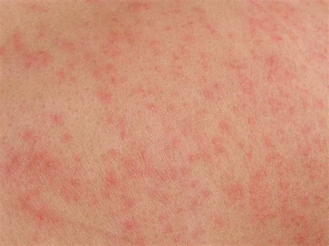 Pictures Of Skin Rashes Skin Rashes Kids Causes And Methods Of