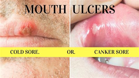 Mouth Ulcers Difference Between Cankerapthoussores And Coldherpes Sores Youtube