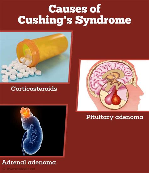Cushings Syndrome Causes Symptoms Diagnosis And Management