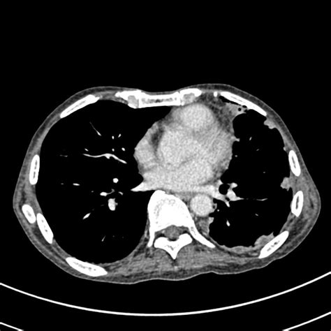 Radiographic features ultrasound it can be seen as a triangular echogenic cortical defect, frequently seen i. Angiomyolipoma differential diagnosis - wikidoc