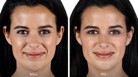 Juvederm Vollure Dermal Fillers Injection By Physician In Irvine