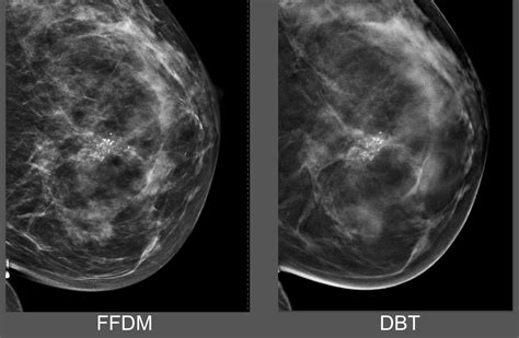 GE Gets FDA Approval For D Mammogram Machine WSJ