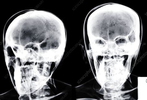 Two Human Skulls X Ray Stock Image F0298790 Science Photo Library