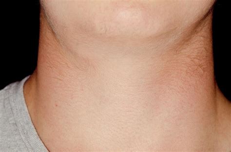 Swollen Lymph Glands In Neck Photograph By Dr P Marazziscience Photo Images And Photos Finder