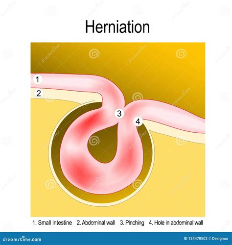 Strangulated Hernia Anatomy Diagram Cartoon Vector
