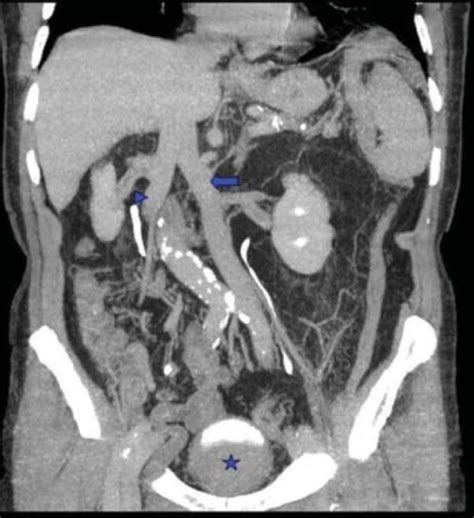 Coronal Abdominal Ct Scan With Reconstruction Shows The Open I