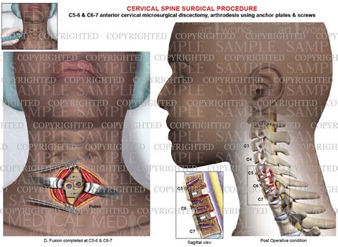C5 6 C6 7 Post Operative Condition Anterior Cervical Discectomy And