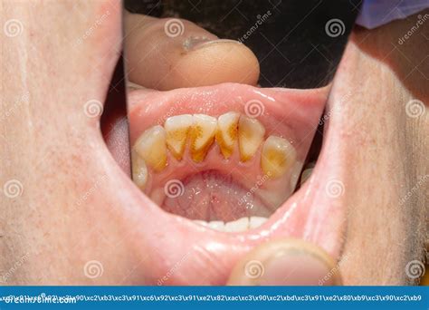 Rotten Teeth Royalty Free Stock Image 35981548