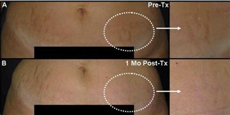 Stretch Marks Laser And Light Treatmetns To Fade Stretchmarks Beverly