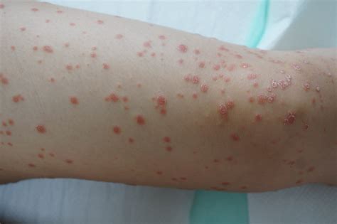 What Does Guttate Psoriasis Look Like