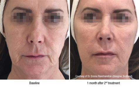 Profhilo Maticlinic Aesthetics ǀ Anti Wrinkle Injections ǀ Dermal Fillers