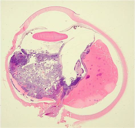 Maybe you would like to learn more about one of these? Ocular Cytopathology: CHAPTER 9- MALIGNANT NEOPLASMS ...