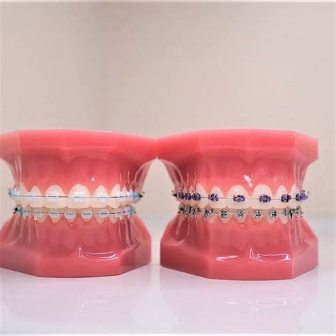 What Are The Benefits Of Metal Braces Blogs Webdental Llc