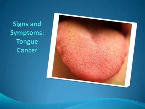 Cancer Symptoms Cancer Symptoms On Tongue