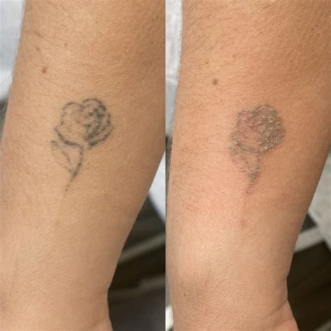 Mens Laser Tattoo Removal Vanilla Pod Beauty