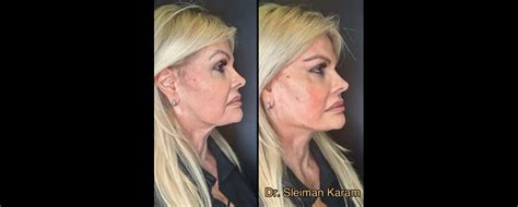 Foto Harmonização facial de Monique Evans antes e depois da modelo surpreendeu Purepeople