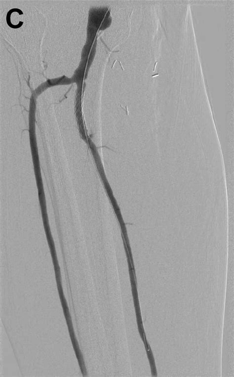 Hybrid Repair Of Concurrent Popliteal Artery And Tibioperoneal Trunk