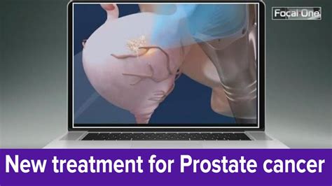 HIFU Prostate Cancer Treatment Offers Non Invasive Alternative YouTube