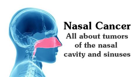 Nasal Cancer All About Tumors Of The Nasal Cavity Sinuses WikiJunkie