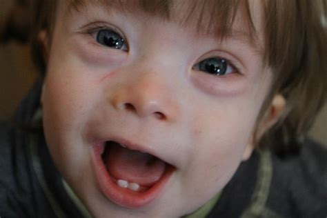 Caregivers also should make sure that children with down syndrome receive all. A Beautiful Life: The Eyes Have It