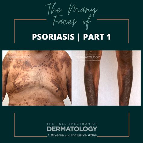 The Many Faces Of Psoriasis Part 1 Next Steps In Dermatology