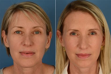 The Uplift Lower Face And Neck Lift Photos Naples Fl Patient 16233